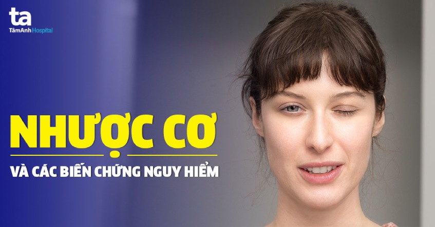 Ngu cơ: Nguyên nhân, triệu chứng và cách điều trị hiệu quả