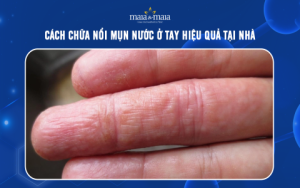 Skin bạch lang là gì? Cách điều trị và phòng ngừa hiệu quả tại nhà