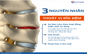 Bệnh bại liệt là gì? Nguyên nhân, triệu chứng và cách phòng ngừa hiệu quả